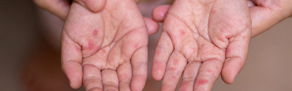 A child's palms showing red spots caused by HFMD.
